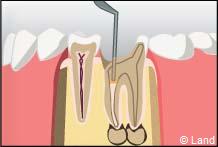 traitement radiculaire