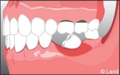 Pour remplacer les dents manquantes