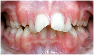 Pour remplacer les dents manquantes