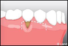 Chirurgie mucogingivale