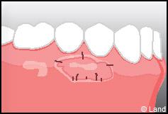 Chirurgie mucogingivale