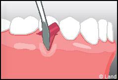 Chirurgie mucogingivale